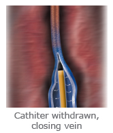 catheter withdrawn
