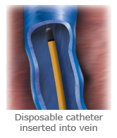 disposable catheter