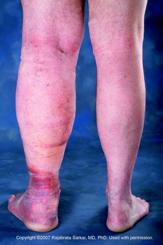 leg-swelling