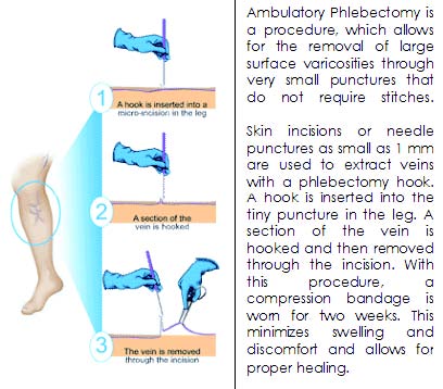 microphlebectomy