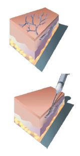 sclerotherapy
