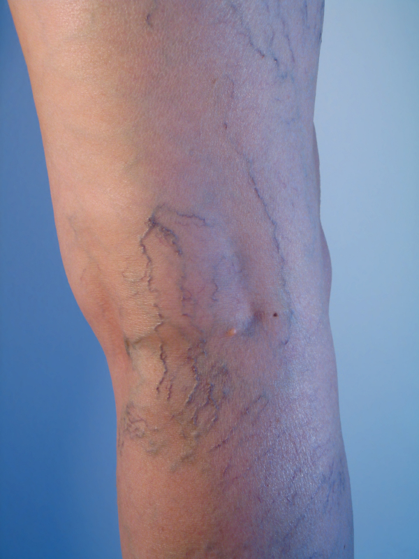 spider-veins