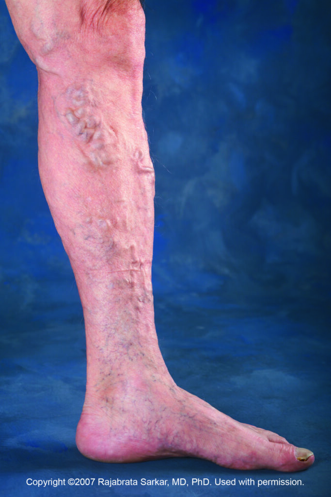 varicose-veins-med