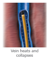 vein heats