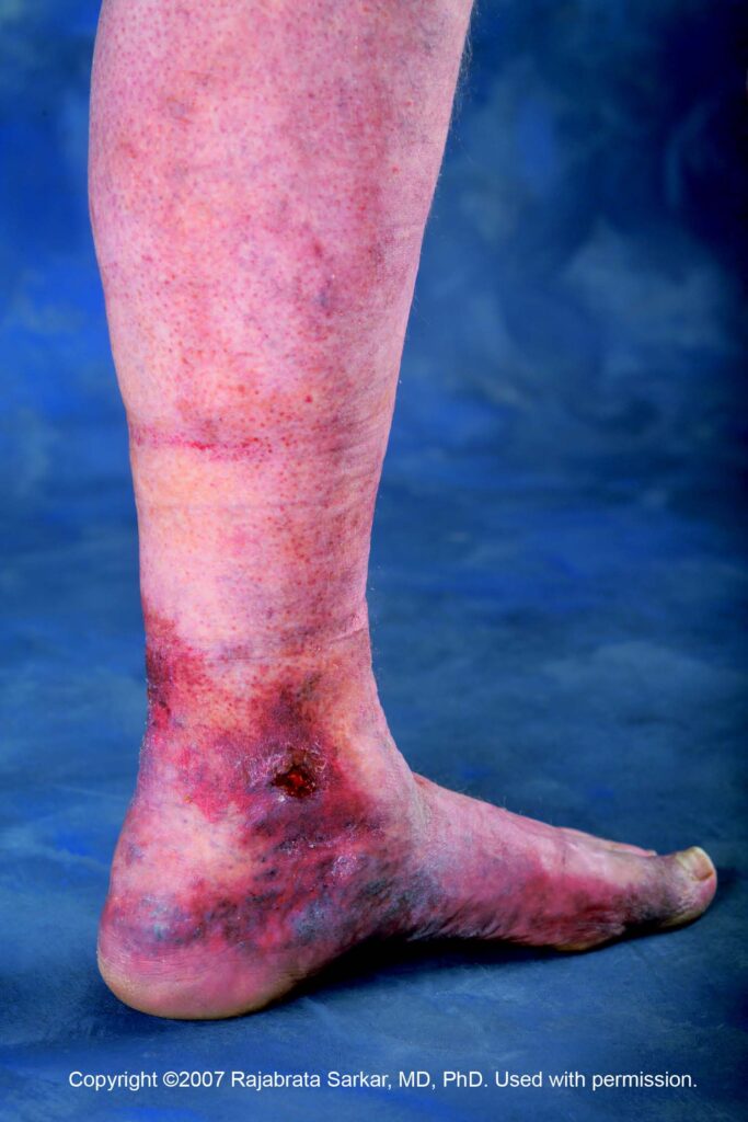 venous-ulcers